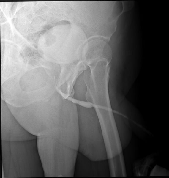 File:Anterior urethral stricture (Radiopaedia 66075-75250 Oblique 1).jpg