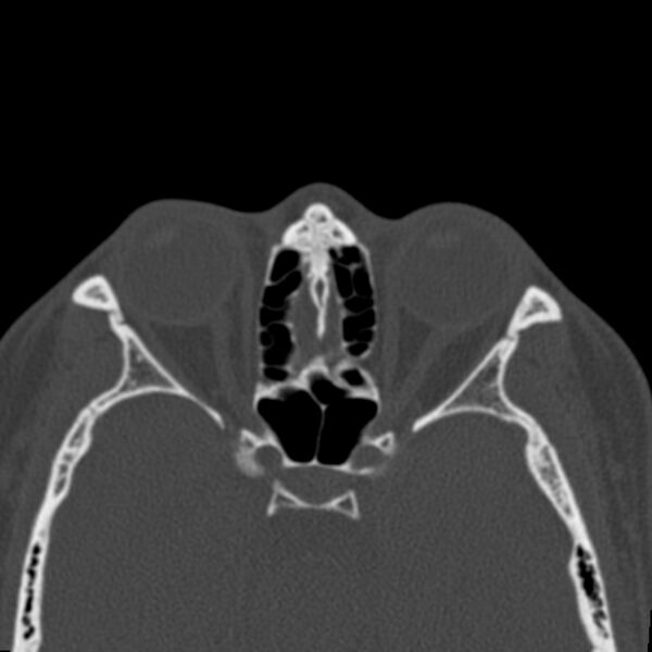 File:Antrochoanal polyp (Radiopaedia 21894-21868 Axial bone window 33).jpg