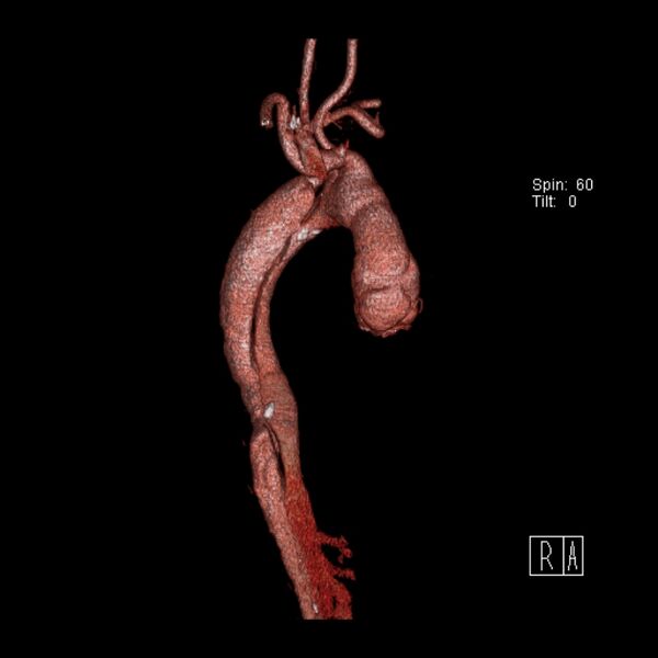 File:Aortic dissection - De Bakey type III - Stanford B (Radiopaedia 21903-21882 3D C+ arterial phase 4).jpg