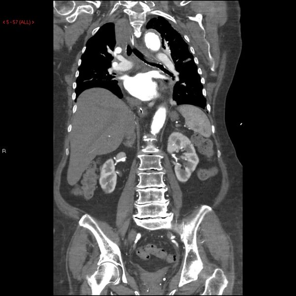 File:Aortic intramural hematoma (Radiopaedia 27746-28001 B 34).jpg