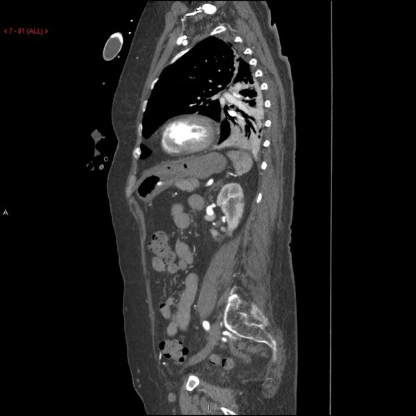 File:Aortic intramural hematoma (Radiopaedia 27746-28001 C 50).jpg