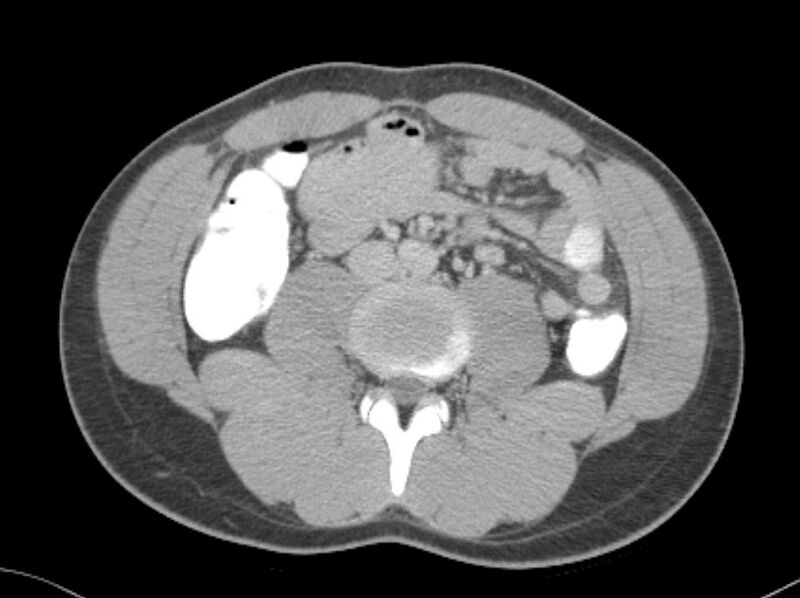 File:Appendicitis and incidental foregut duplication cyst (Radiopaedia 52962-58916 A 39).jpg