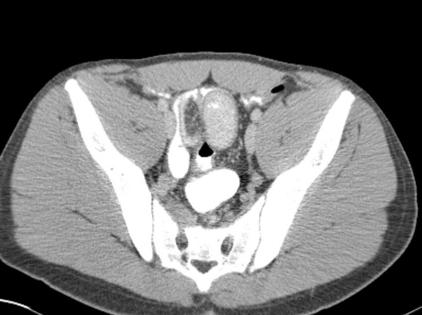 Appendicitis and incidental foregut duplication cyst (Radiopaedia 52962-58916 A 80).jpg