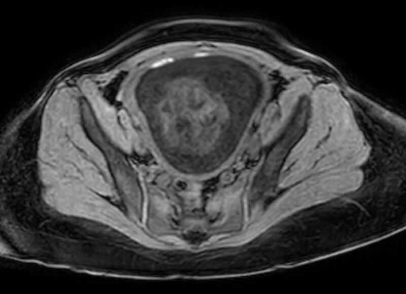 File:Appendicitis in gravida (MRI) (Radiopaedia 89433-106395 Axial DIXON 121).jpg