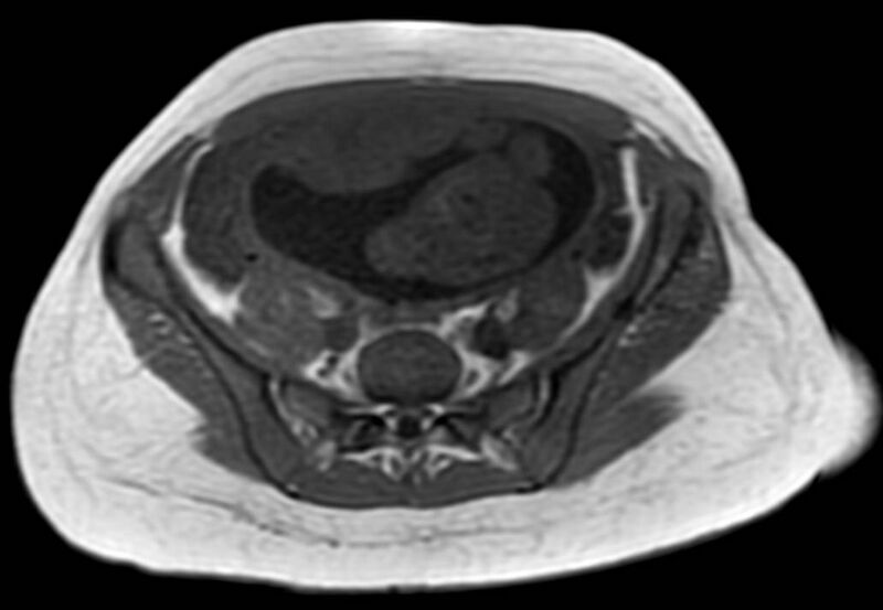 File:Appendicitis in gravida (MRI) (Radiopaedia 89433-106395 Axial T1 in-phase 49).jpg