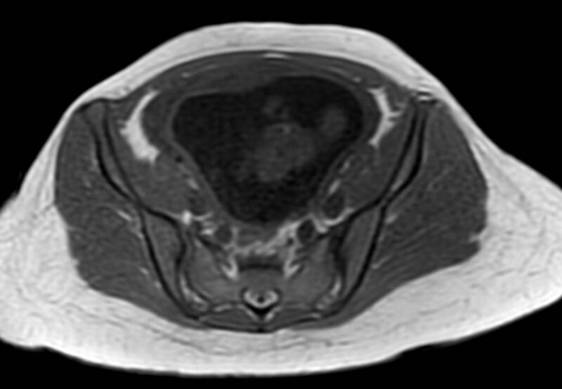 File:Appendicitis in gravida (MRI) (Radiopaedia 89433-106395 Axial T1 in-phase 54).jpg