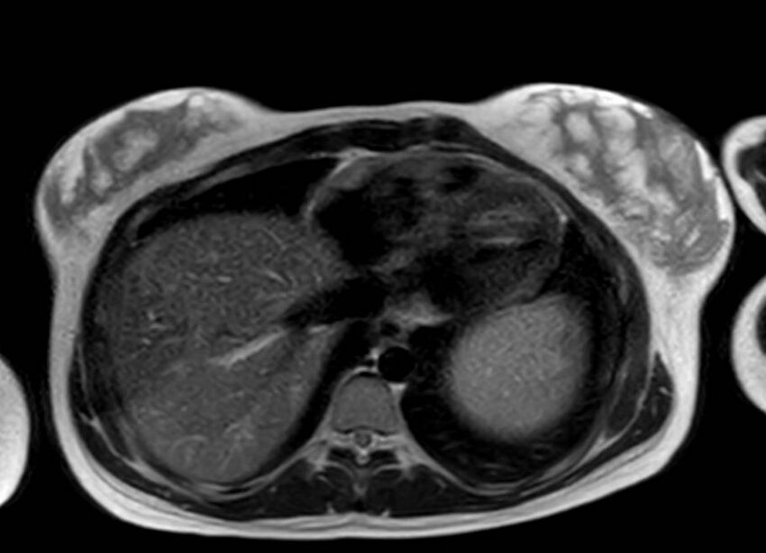 Appendicitis in gravida (MRI) (Radiopaedia 89433-106395 Axial T2 2).jpg
