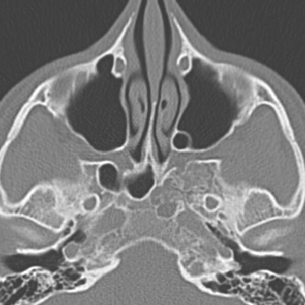 File:Arrested pneumatization of the sphenoid (Radiopaedia 10700-11172 Axial non-contrast 7).jpg
