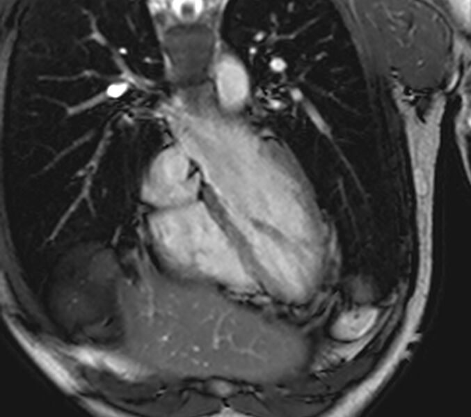 File:Arrhythmogenic right ventricular cardiomyopathy (Radiopaedia 39806-42237 D 135).jpg