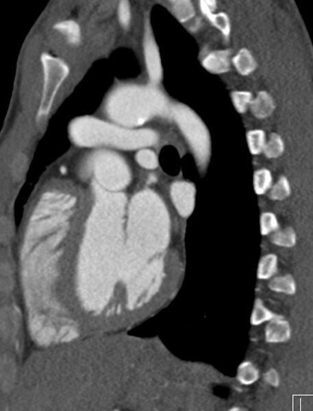 File:Arterial switch procedure (Radiopaedia 31607-32493 Sagittal 19).jpg