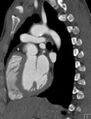 Arterial switch procedure (Radiopaedia 31607-32493 Sagittal 19).jpg