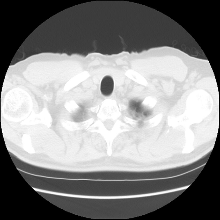 Asbestos-related pleural plaques (Radiopaedia 39069-41255 Axial lung window 4).jpg