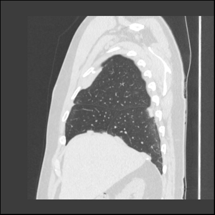 Asbestosis (Radiopaedia 45002-48961 Sagittal lung window 110).jpg