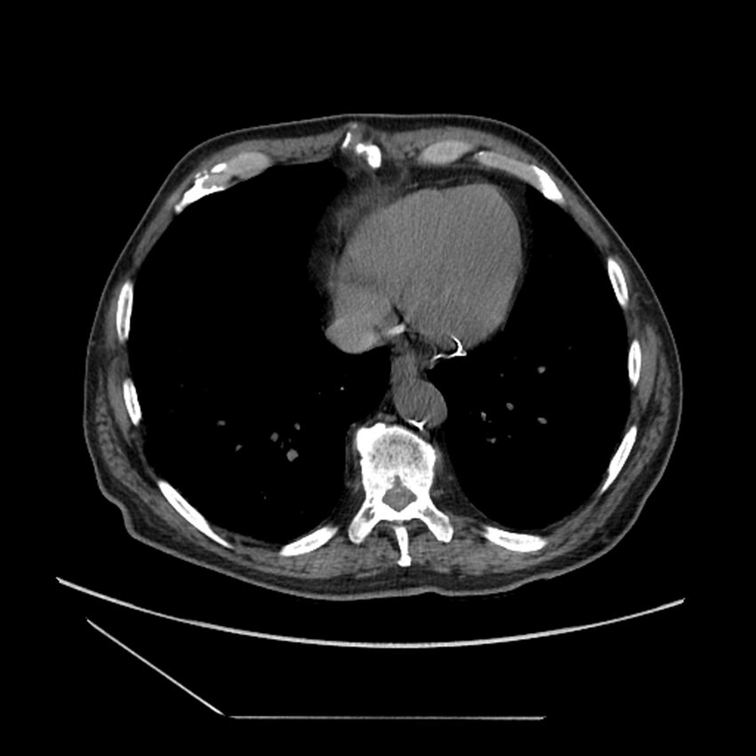 Asbestosis complicated by lung cancer (Radiopaedia 45834-50116 Axial non-contrast 49).jpg