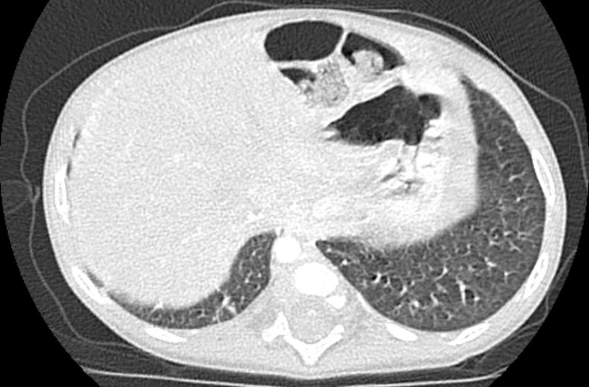 Asplenia syndrome (Radiopaedia 73083-83792 Axial lung window 67).jpg