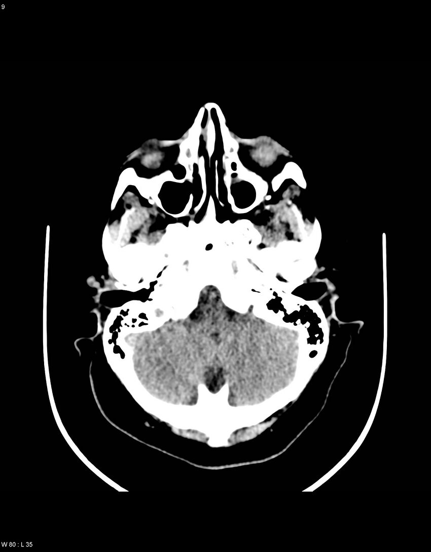 Astroblastoma (Radiopaedia 39792-42216 Axial non-contrast 8).jpg