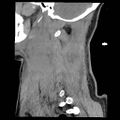 Atlanto-occipital dislocation (Radiopaedia 44648-48412 A 4).jpg