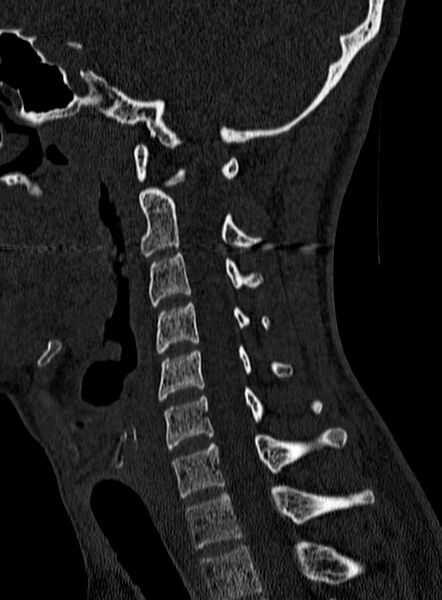 File:Atlantoaxial subluxation (Radiopaedia 44681-48450 Sagittal bone window 91).jpg