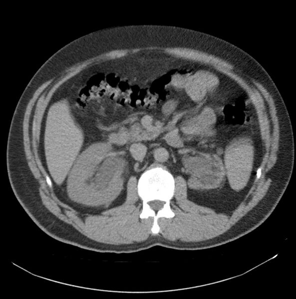 File:Atrophic kidney due to severe chronic obstructive hydronephrosis (Radiopaedia 40828-43474 Axial non-contrast 5).jpg