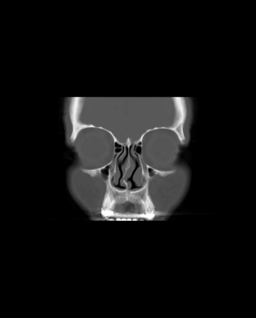 Automastoidectomy with labyrinthine fistula (Radiopaedia 84143-99411 Coronal non-contrast 14).jpg
