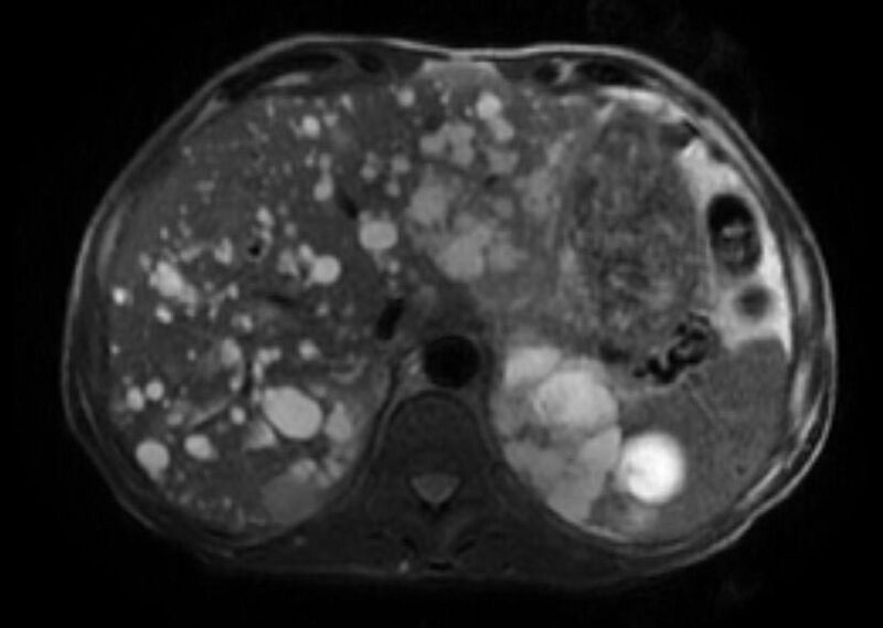 File:Autosomal dominant polycystic kidney disease (Radiopaedia 11220-11585 Axial T2 fat sat 1).jpg