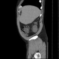 Autosomal dominant polycystic kidney disease (Radiopaedia 36539-38101 D 12).jpg