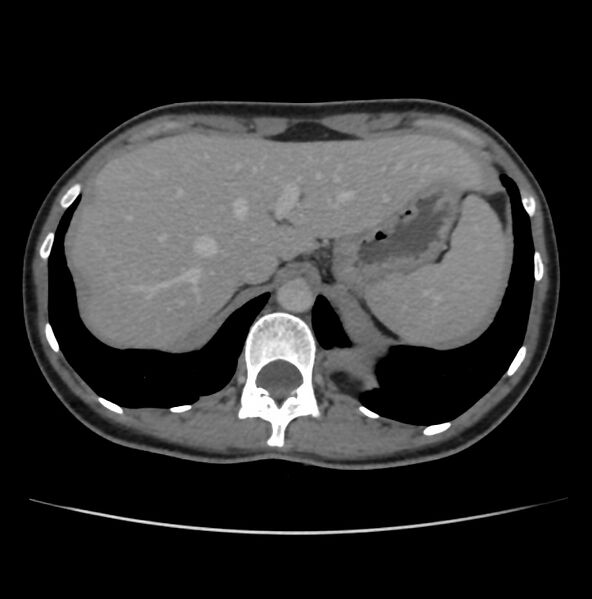 File:Autosomal dominant polycystic kidney disease - early onset (Radiopaedia 40734-43387 A 4).jpg