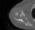 Avulsion fracture - greater tuberosity of humerus (Radiopaedia 71216-81514 Axial bone window 25).jpg