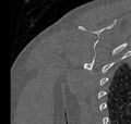 Avulsion fracture - greater tuberosity of humerus (Radiopaedia 71216-81514 Coronal bone window 64).jpg