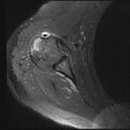 Avulsion fracture - greater tuberosity of humerus (Radiopaedia 71216-81515 Axial PD fat sat 6).jpg