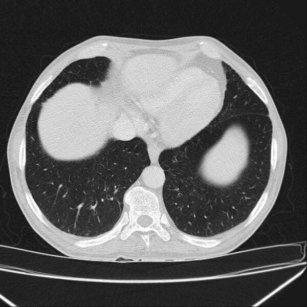 File:Azygos lobe (Radiopaedia 38259-40275 Axial lung window 65).jpg
