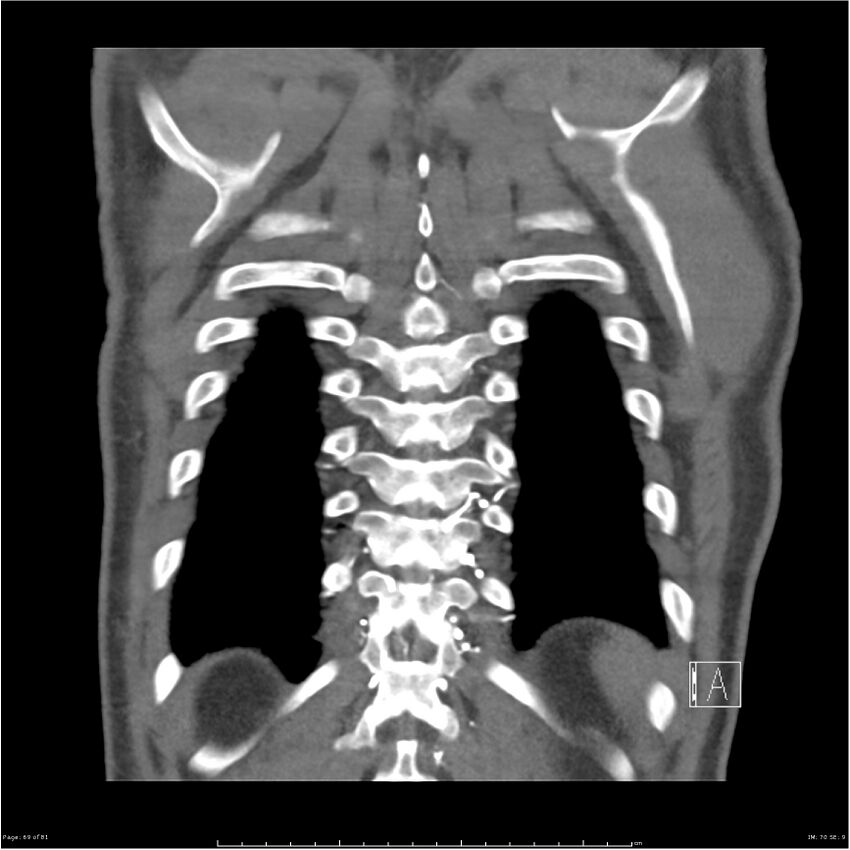 Azygos venous system anatomy (CT pulmonary angiography) (Radiopaedia 25928-26077 Coronal C+ CTPA 69).jpg