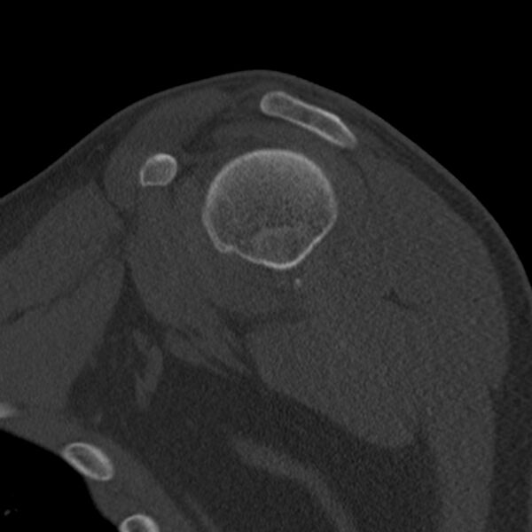 File:Bankart lesion (Radiopaedia 22771-22798 Sagittal bone window 21).jpg
