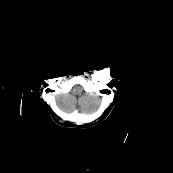 File:Basal ganglia hemorrhage (Radiopaedia 58349-65472 Axial non-contrast 49).jpg