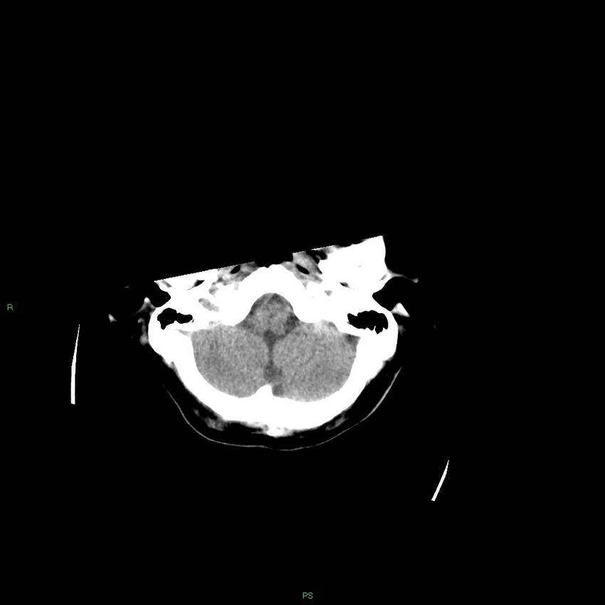 Basal ganglia hemorrhage (Radiopaedia 58349-65472 Axial non-contrast 49).jpg