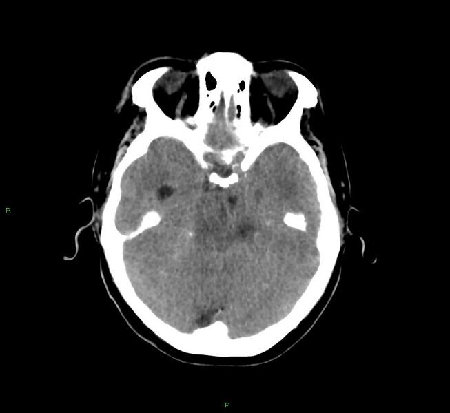 File:Basal ganglia hemorrhage (Radiopaedia 58775-66008 Axial non-contrast 41).jpg