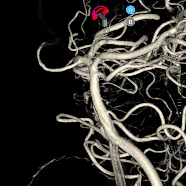 File:Basilar artery perforator aneurysm (Radiopaedia 82455-97734 3D view left VA 30).jpg