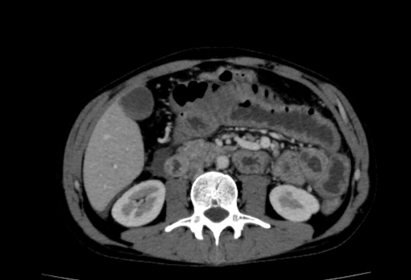 File:Behçet's disease- abdominal vasculitis (Radiopaedia 55955-62570 A 37).jpg