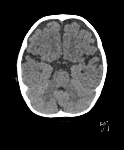 File:Benign enlargement of subarachnoid spaces in infancy (BESS) (Radiopaedia 87459-103795 Axial non-contrast 62).jpg