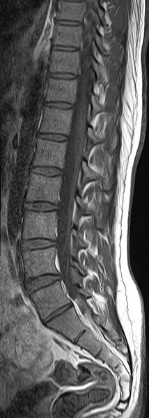File:Bertolotti syndrome (Radiopaedia 67714-77132 Sagittal T1 7).jpg