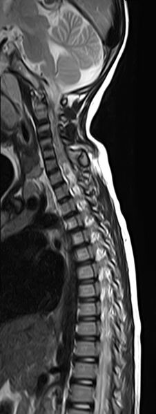 File:Bilateral Sprengel deformity with Klippel-Feil syndrome (Radiopaedia 66395-75650 Sagittal T2 8).jpg