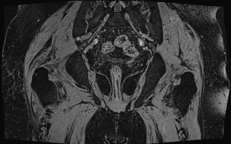 File:Bilateral avascular necrosis of femoral head (Radiopaedia 77116-89078 Coronal T2 we 3).jpg