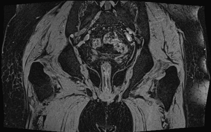 File:Bilateral avascular necrosis of femoral head (Radiopaedia 77116-89078 Coronal T2 we 6).jpg
