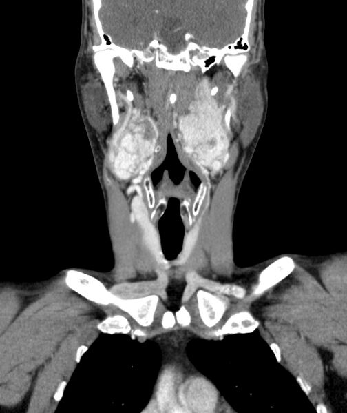 File:Bilateral carotid body tumors (Radiopaedia 52899-58827 B 17).jpg