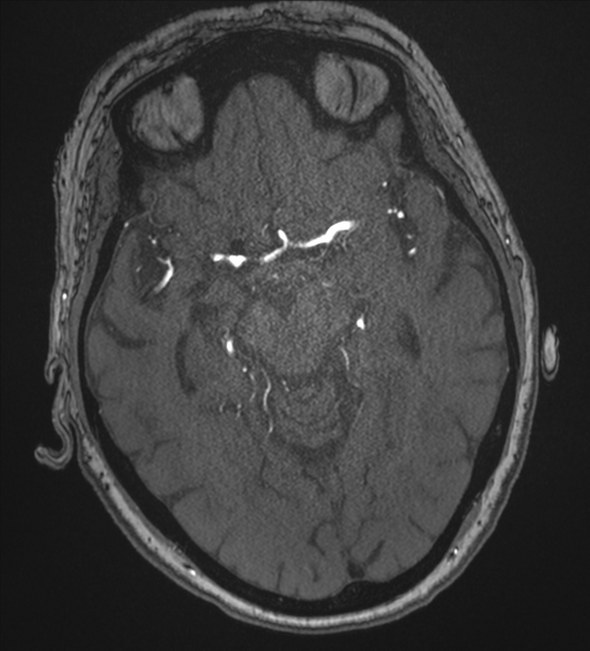 File:Bilateral fetal posterior communicating arteries (Radiopaedia 41286-44102 Axial MRA 88).png
