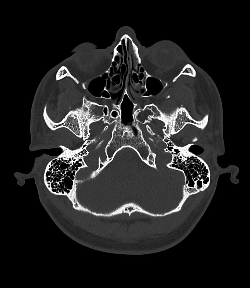 Bilateral medial canal fibrosis (Radiopaedia 85598-101344 Axial bone window 5).jpg