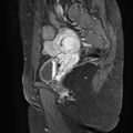 Bilateral ovarian endometriomas (Radiopaedia 87085-103347 F 17).jpg