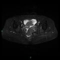Bilateral ovarian fibroma (Radiopaedia 44568-48293 Axial STIR 18).jpg