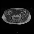 Bilateral ovarian fibroma (Radiopaedia 44568-48293 Axial T1 7).jpg