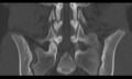 Bilateral pars defect (Radiopaedia 26691-26846 Coronal bone window 29).jpg